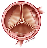aortic-valve-normal