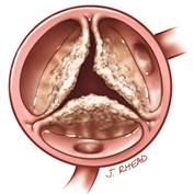 aortic-valve-stenosis-thumb