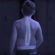 magec-treating-scoliosis-with-magnets