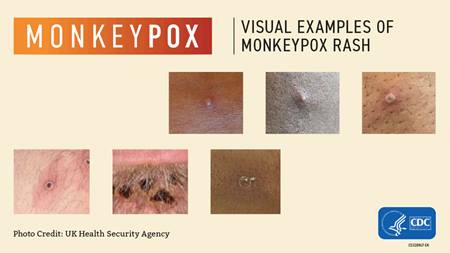 Monkeypox-Visual