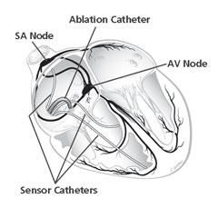 ablation