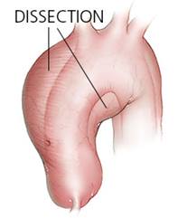 aortic-dissection