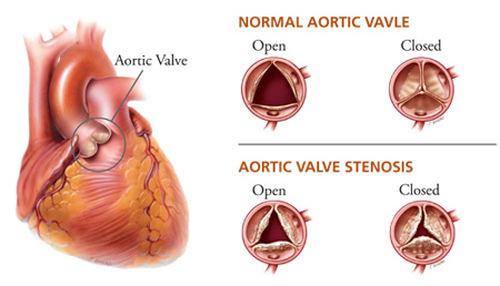 Aortic Valve Stenosis | Heart Care | Intermountain Healthcare