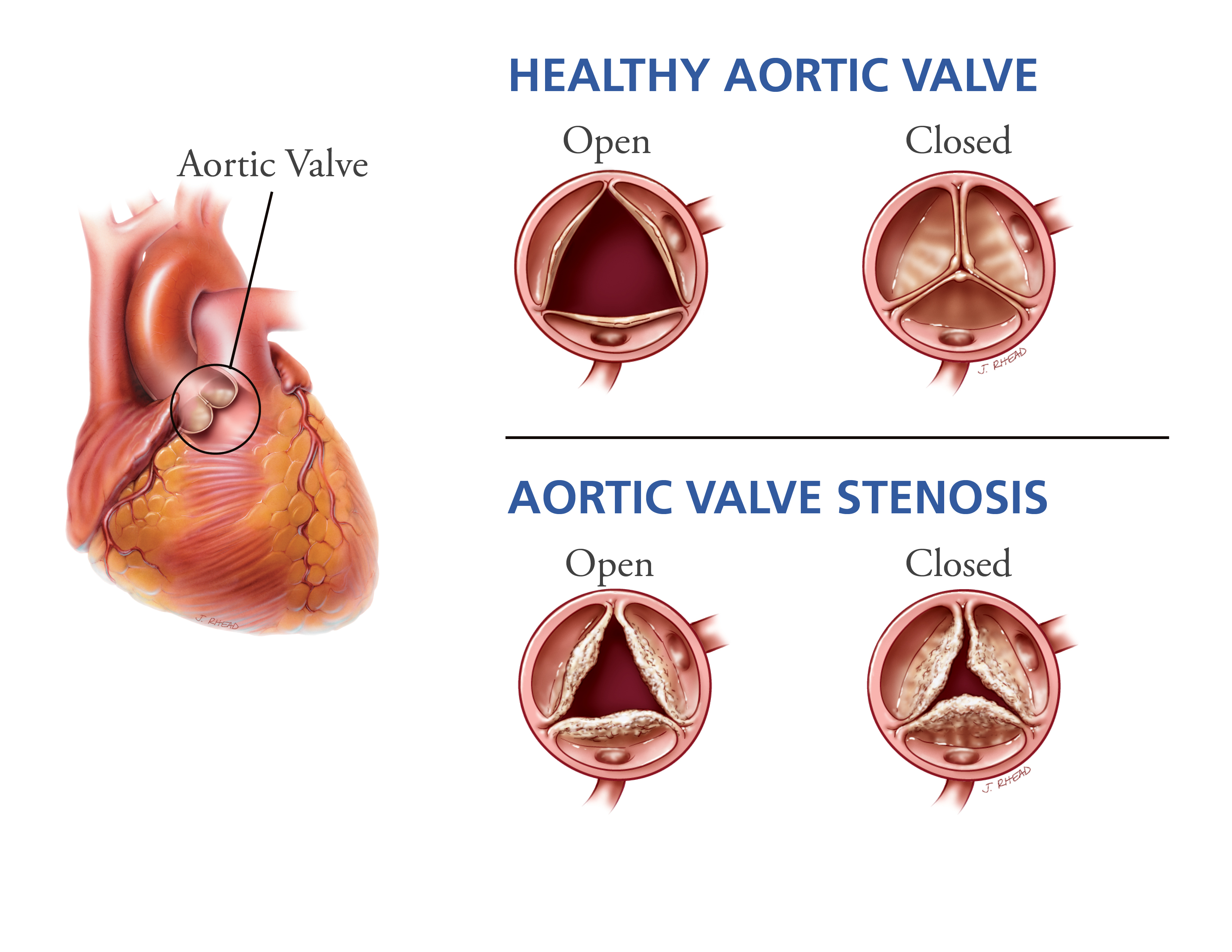 Aortic Stenosis Stages