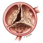 bicuspid-aortic-valve-thumb