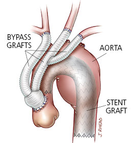 hybrid-aortic-repair