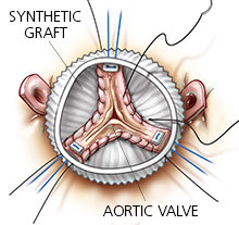 spared-aortic-valve