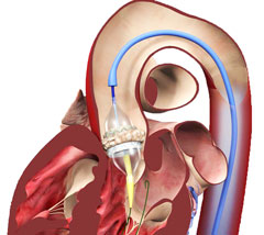 Transcatheter Aortic Valve Replacement Heart Care