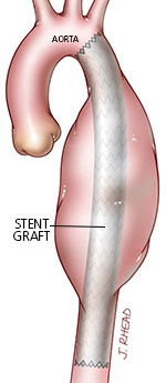 tevar-stent-graft