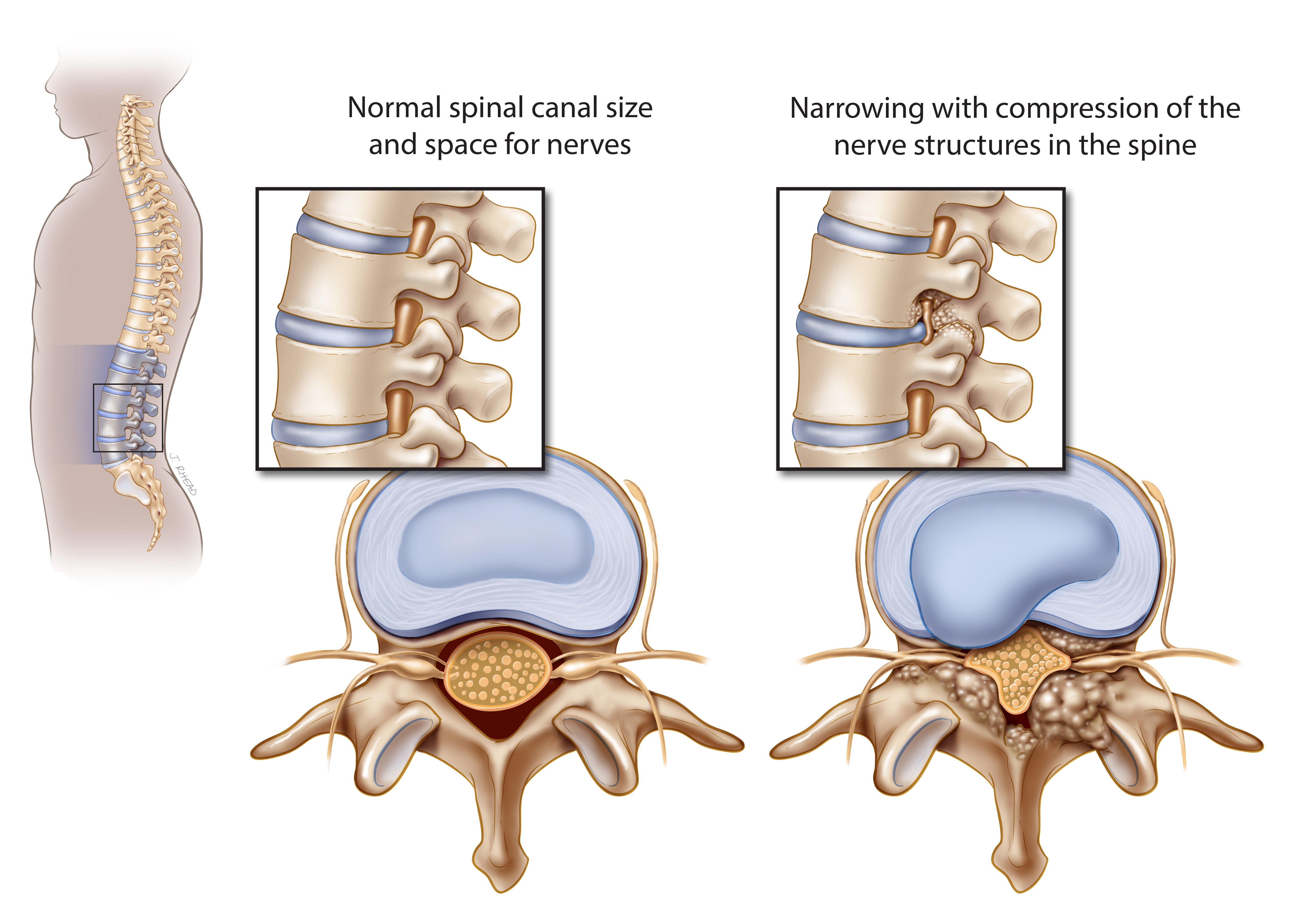 lumbar spinal stenosis illustration
