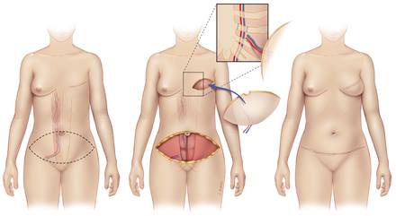 Flap or natural tissue reconstruction - Plastic and Reconstructive Surgery