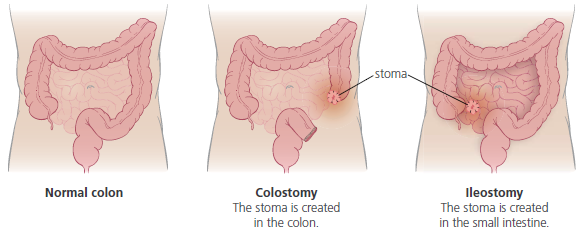 colostomy care procedure