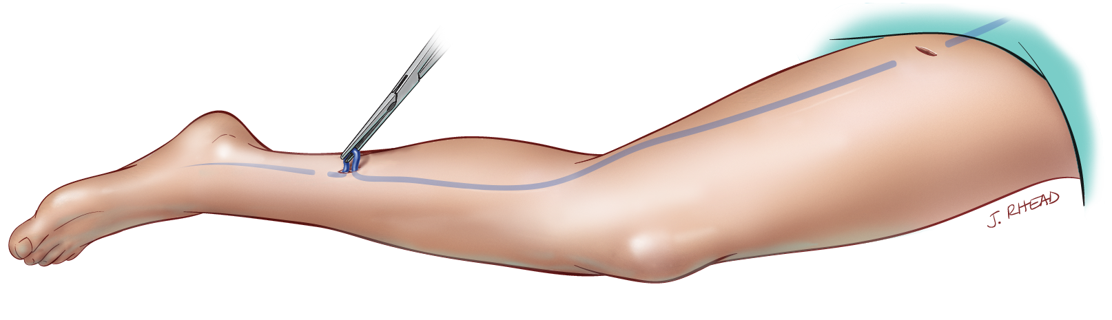 Varicose veins surgery