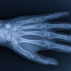 Hand and Wrist x ray