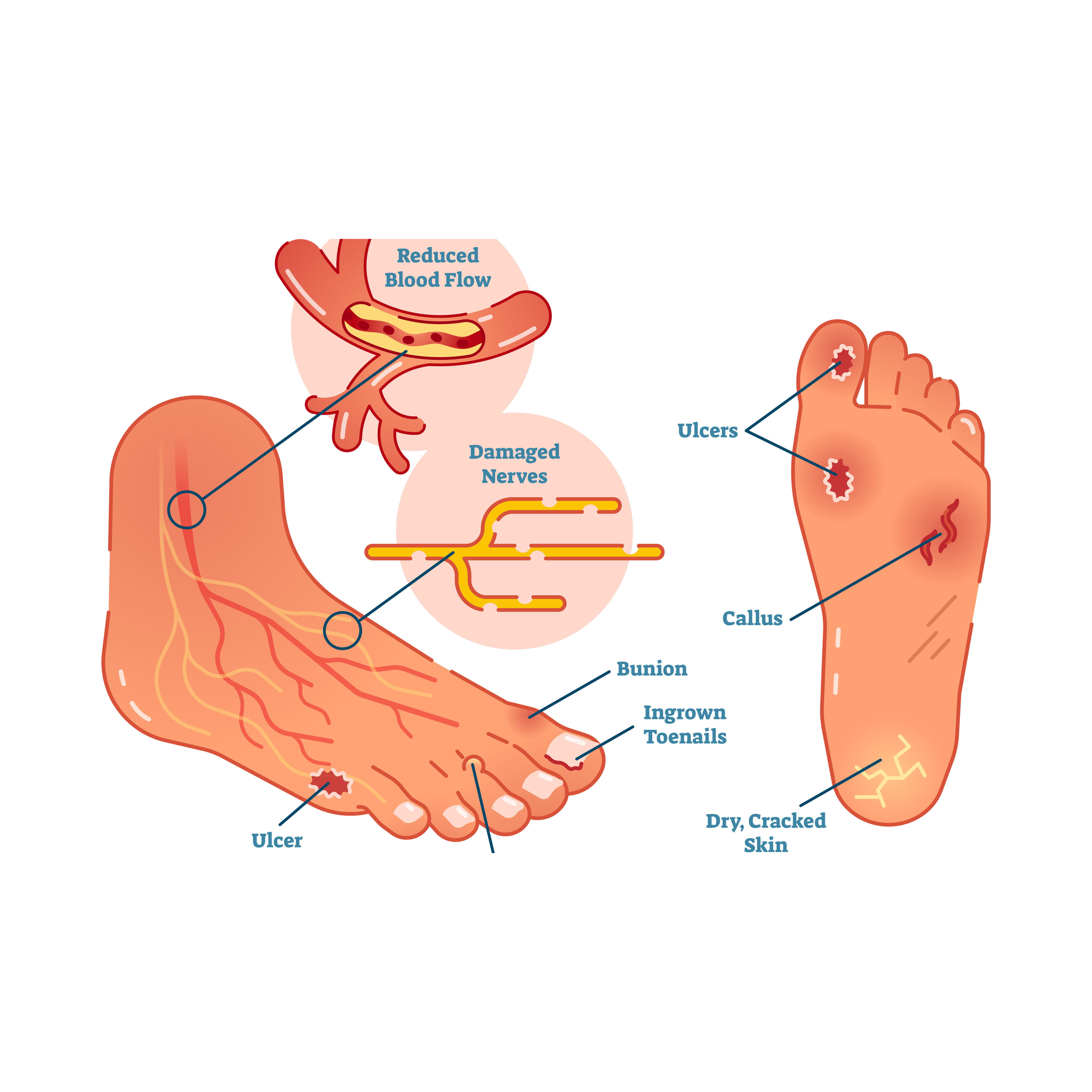 Diabetic neuropathy foot care