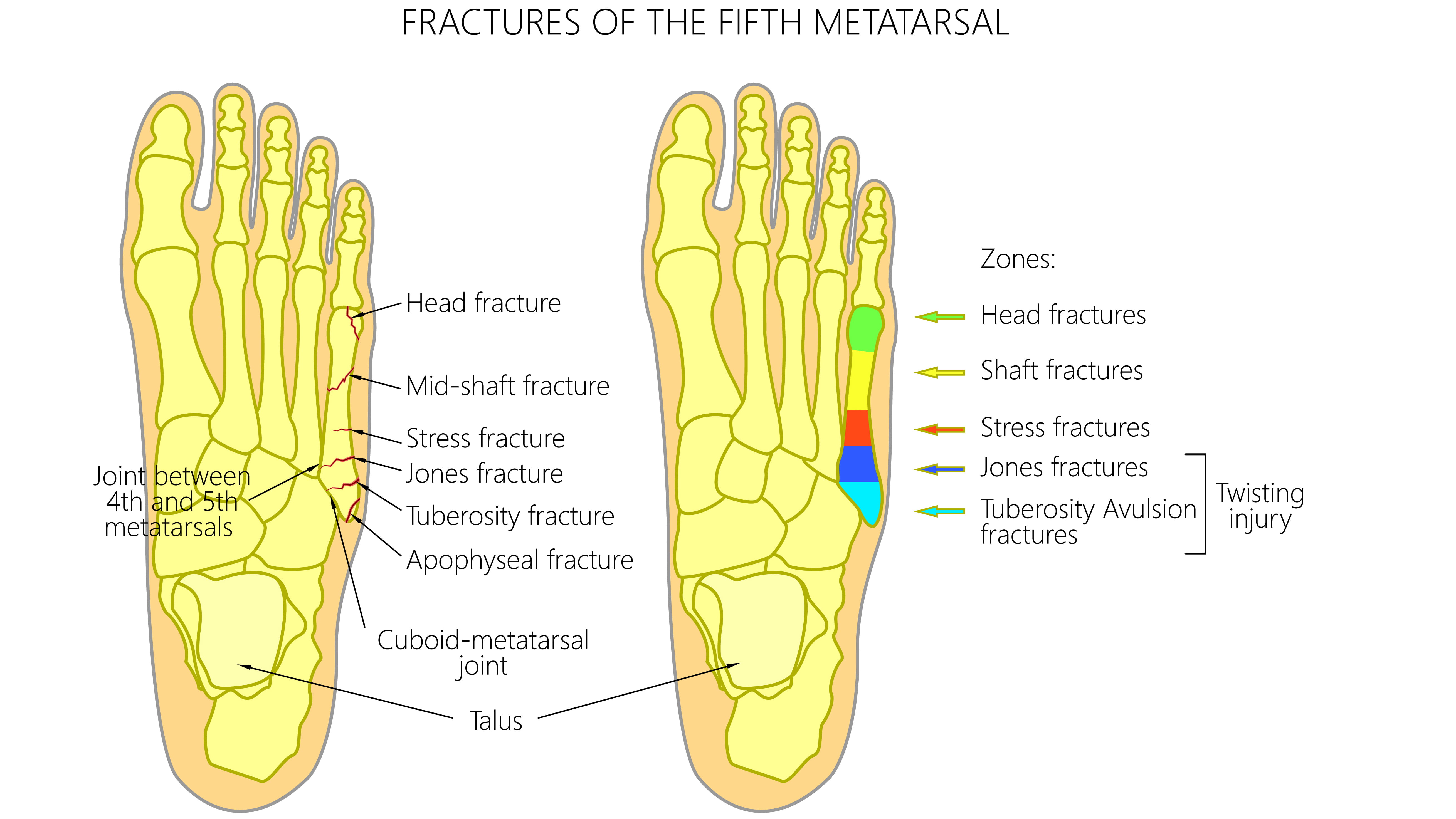 How to Heal Quickly from a Stress Fracture