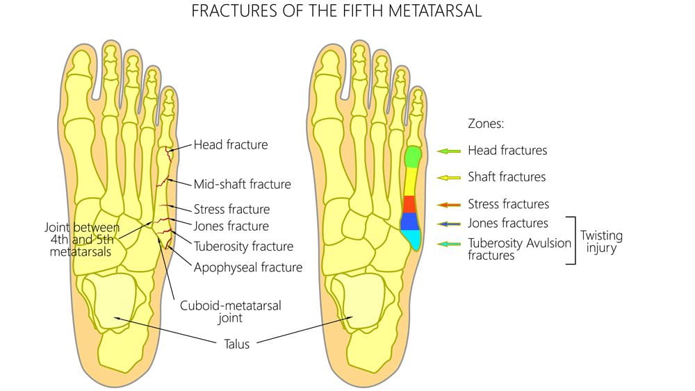 Stress Fractures Foot Ankle | Orthopedics Sports Medicine