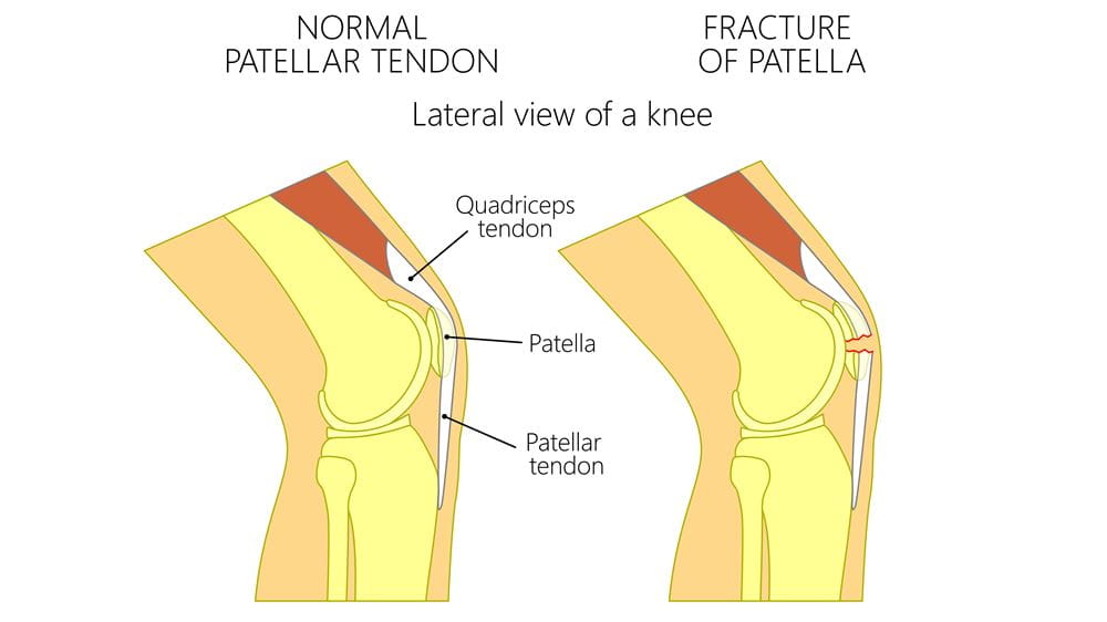 patella fracture