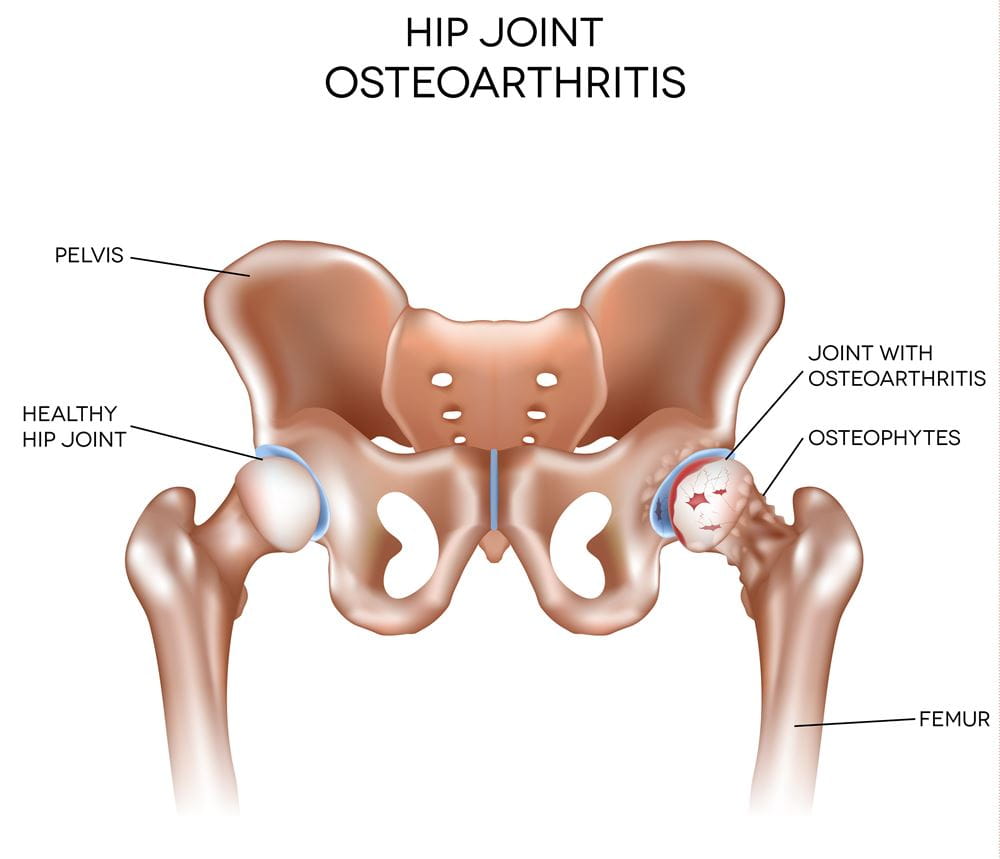 Hip Osteoarthritis  Orthopedics Sports Medicine