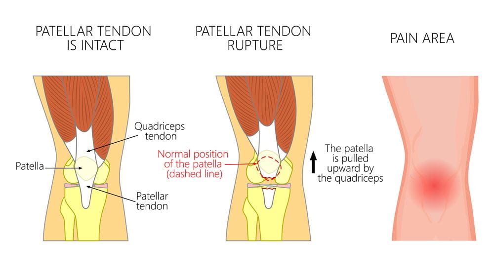 Patellar Tendon Rupture  Orthopedics Sports Medicine