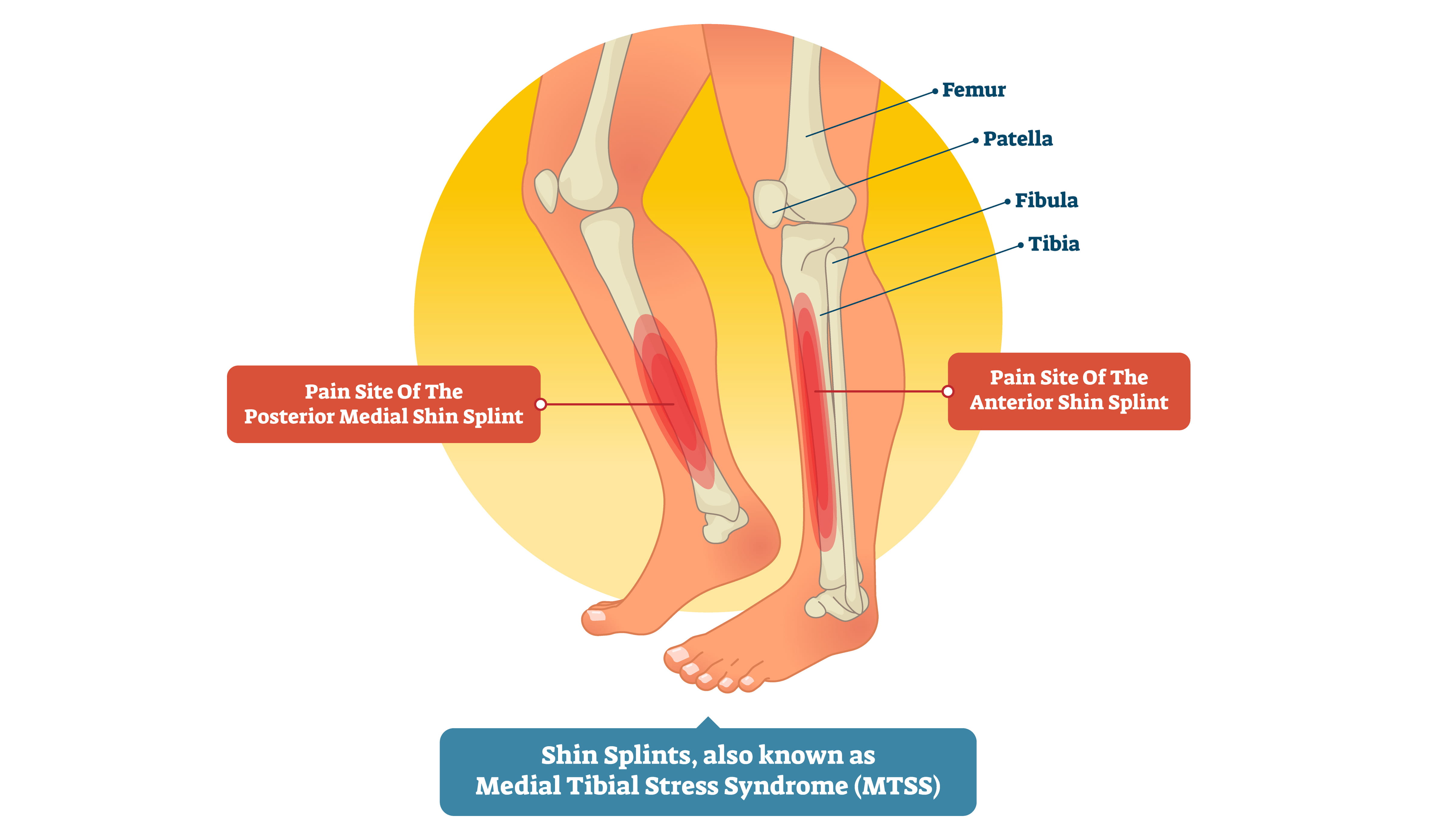 Shin Splints | Orthopedics Sports Medicine