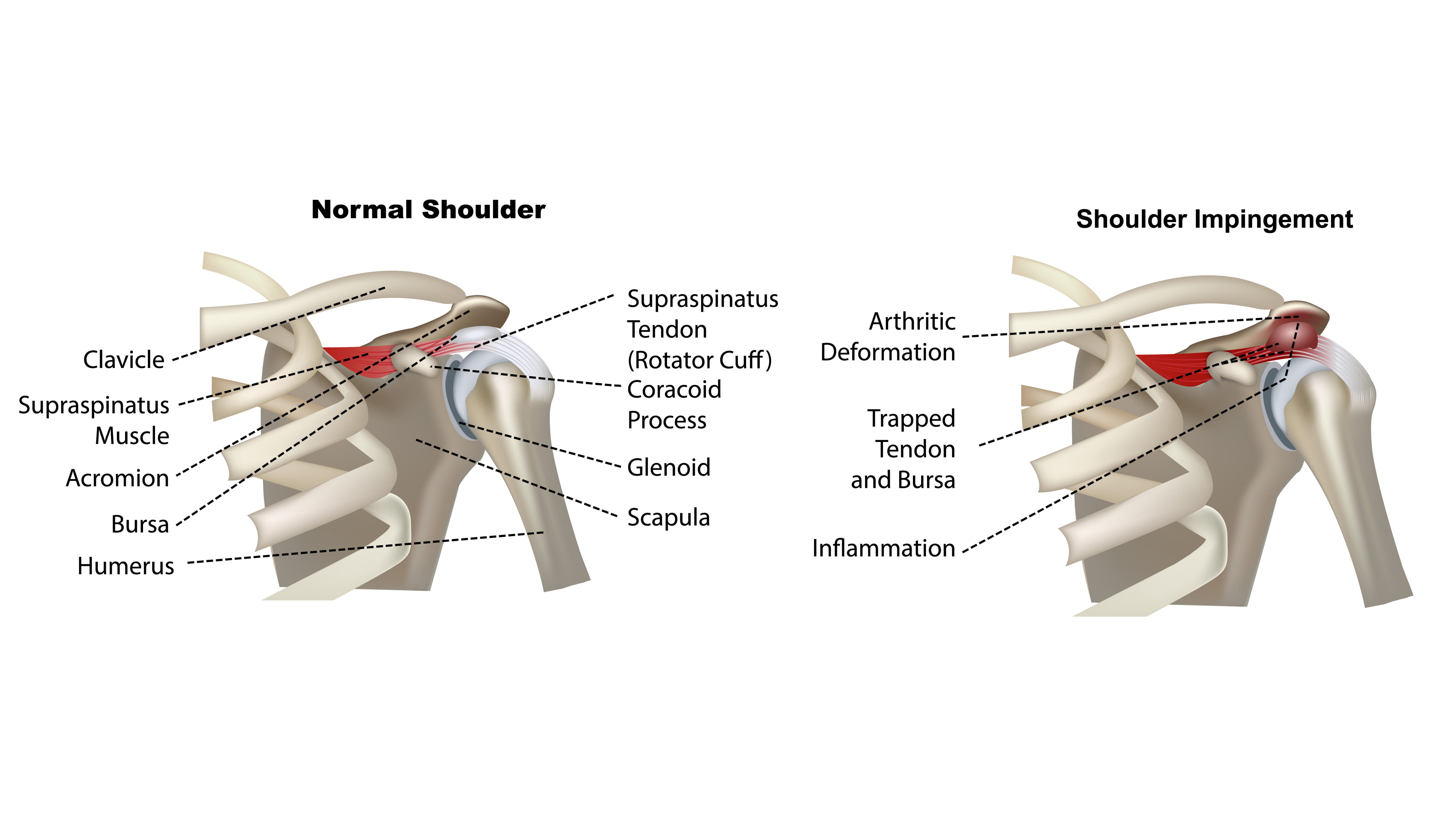 Shoulder Impingement Therapies Outlet USA | Contratacion.fundovidaips.com