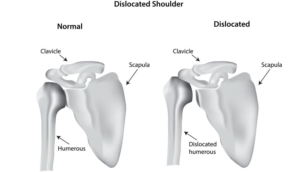 Treating Your Shoulder Dislocation and Preventing it in the Future