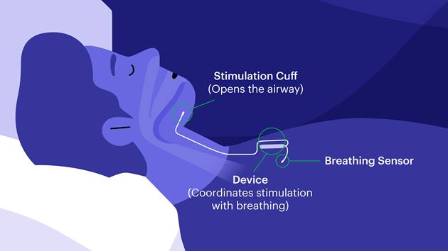 Graphic showing where the stimulation cuff, device, and breathing sensor are inserted