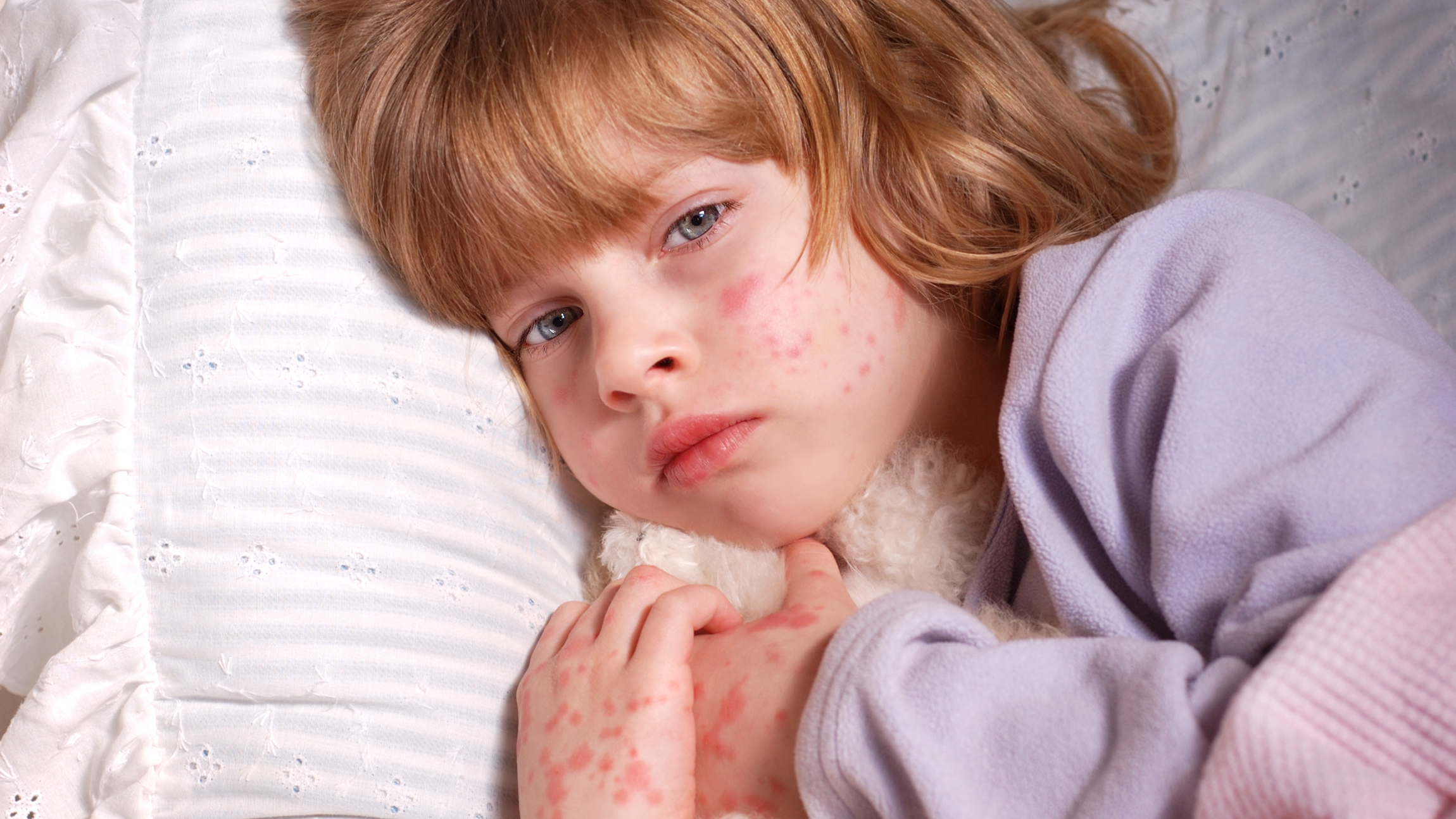 toddler allergy rash