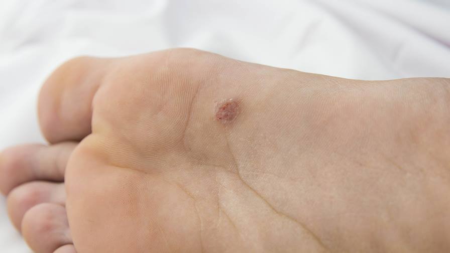 Plantar warts treatment and causes