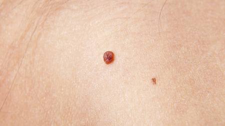 Unsightly Skin Tags