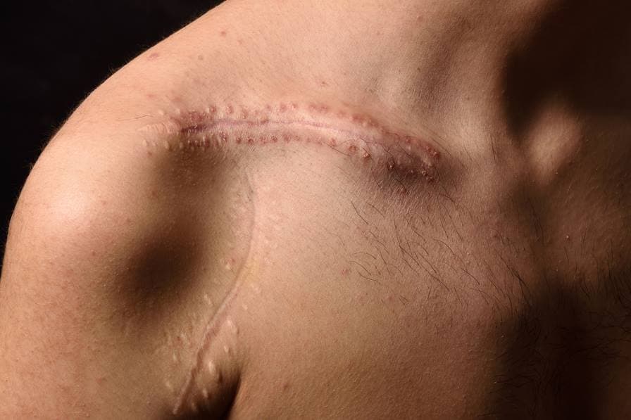 Person with post-surgery scars